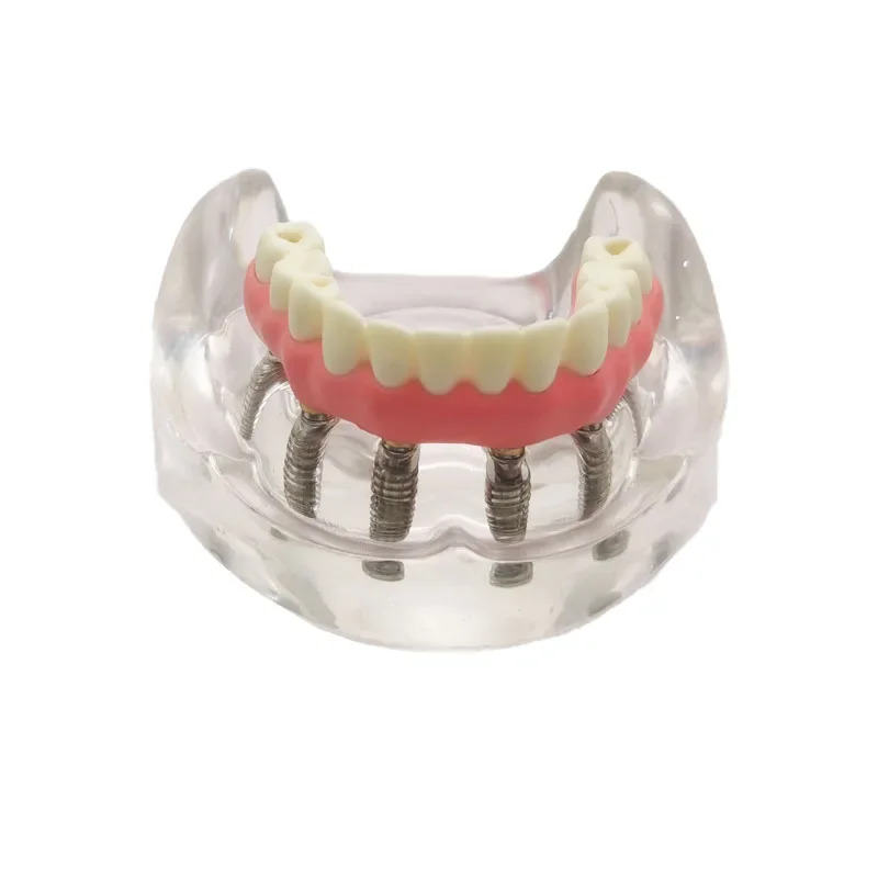 Model implantu dentystycznego z implantacją Overdenture główny dolny implant zębów wymienny model dla dentysty nauczanie i nauki Demo