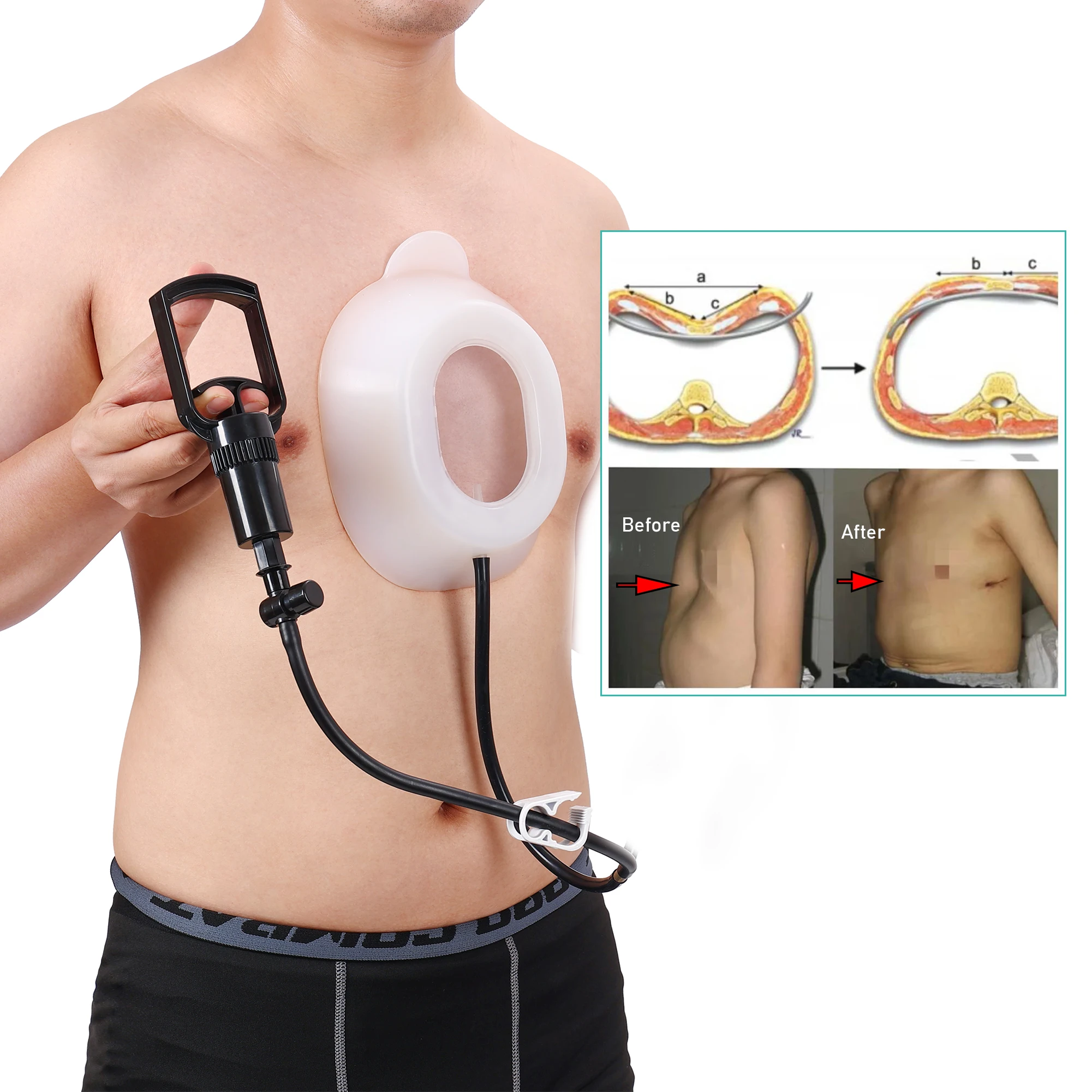 Pectus Excavatum Orthosis Brace, Sternal Depression Support, Thoracic Depression Brace, Sunken Sternum Deformity Braces for All