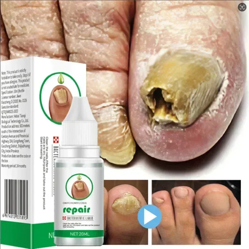 

Fungal Nail Laser Device Repair Fast Nails Fungus Onychomycosis Repair Toenail Fingernail Removes Nail Fungus Foot Care SF888N9