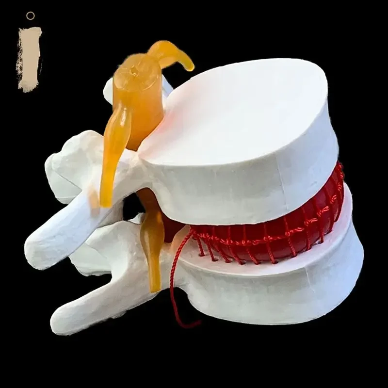 Anatomical Human Lumbar Vertebrae Degenerative Lumbar Disc Herniation Demonstration Model Human Spine Model - White, Yellow