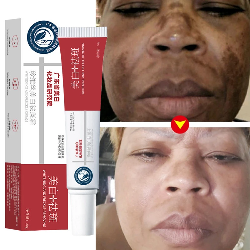 

Freckle Whiten Cream Effective Removing Spot Eliminate Brown Stain Melasma Melanin Blemishes Lighten Moisturiser Face Skin Care