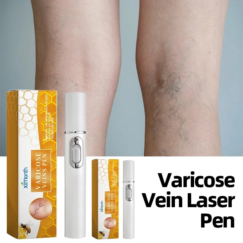 

Varicose Veins Laser Therapy Pen For Men And Women Relieve Leg Pain Improves Moderate Varicose Vein Improve Blood Circulation