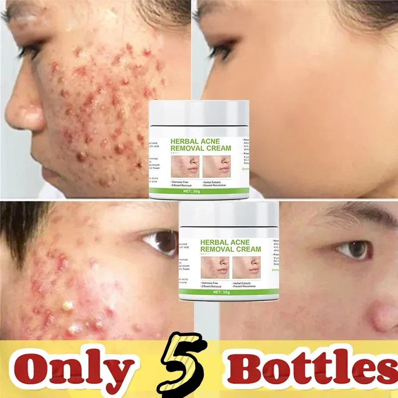 

Acne Removal serum Acne-removing oil Improve Acne Pimple Moisturizer face Repair oil Control Skin Care Products