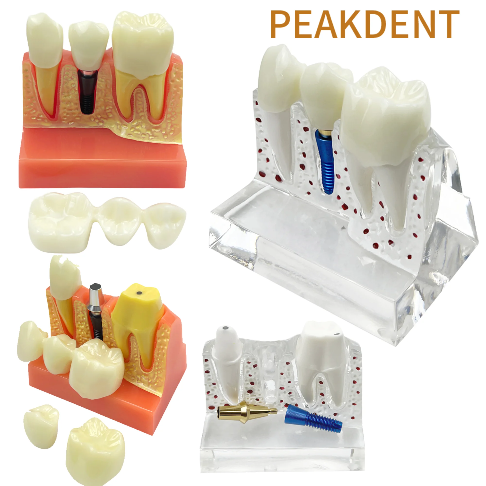 Dental Model 4 Times Dental Implant Analysis Crown Bridge Demonstration Dental Teeth Model Dentistry Demonstration Teeth  Model