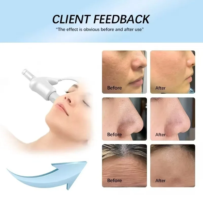 جهاز تجميل لشد الجلد من ديرما Electroporation فائق التوصيل، جهاز رفع مضاد للتجاعيد ومضاد للتجاعيد