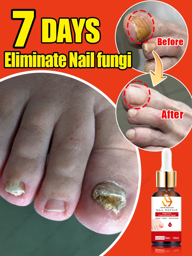 

Eliminate Nail fungi