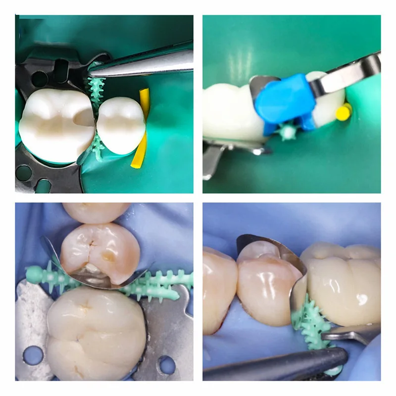 40 ชิ้น/กล่องทิ้งทันตกรรมซิลิโคน Adaptive Wedges Interdental Contoured ฟัน Wedge เครื่องมือทันตกรรม