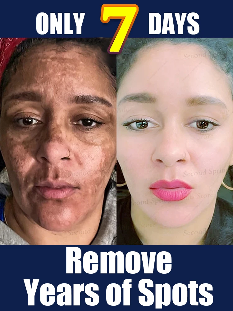 

Powerful Cream Fast Skin Lightening Solve Melasma Dark Spots