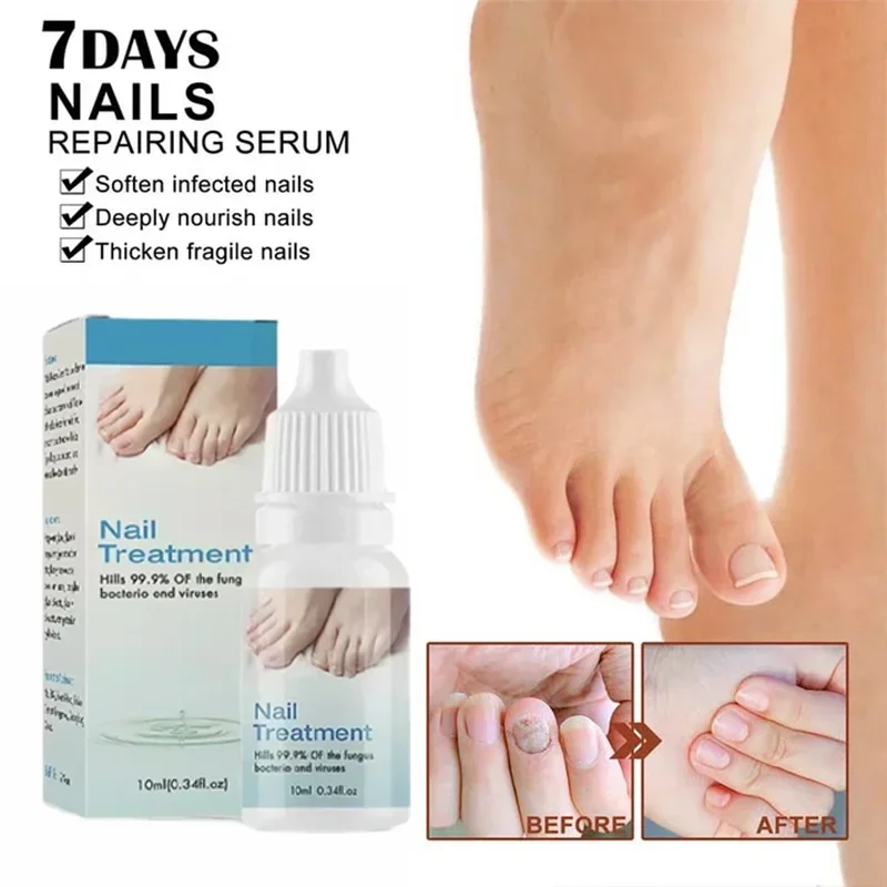 Fungal Nail Removal 10ML Fungal Nail Treatment Oil Foot Repair Essence Toe Nail Fungus Removal Gel Anti Infection Cream