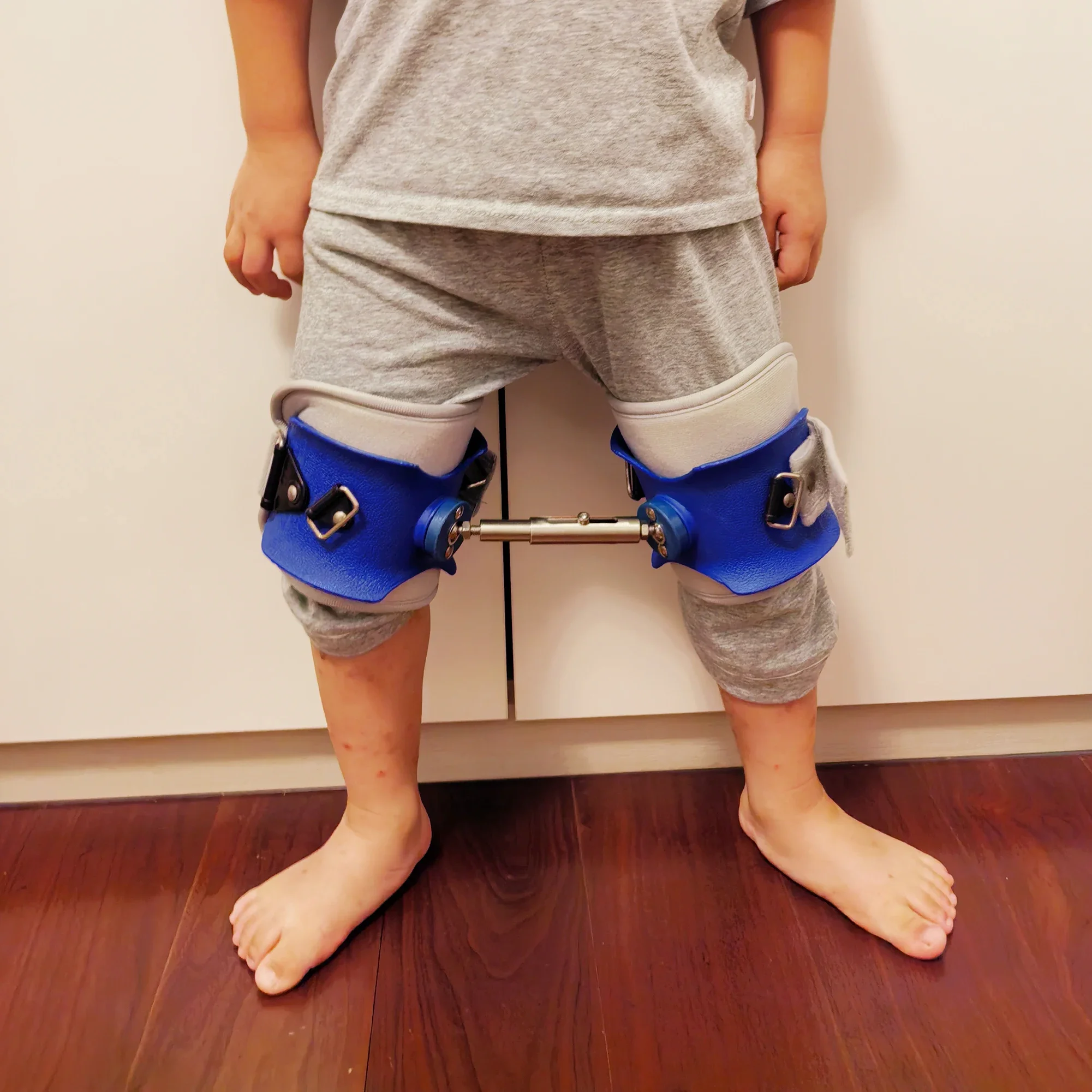 Customizable Child Pediatric Bar Hip Abduction Orthosis for Developmental Dysplasia of The Hip and Congenital Hip