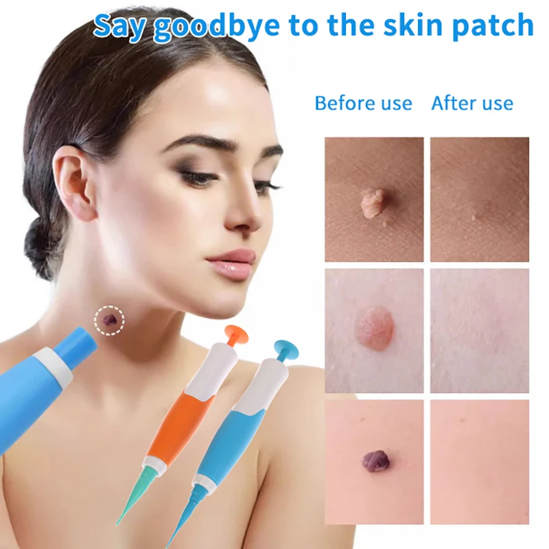 

Auto Skin Tag Removal Kit 1-8mm Band Painless Mole Wart Skin Tag Remover Pen Wart Dot Corn Treatments Body Facial Beauty Tool