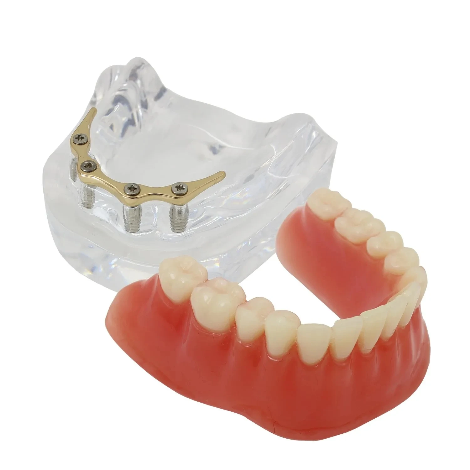 Dental Teeth Model Precision 4 Implant Overdenture Inferior Tooth Golden Color