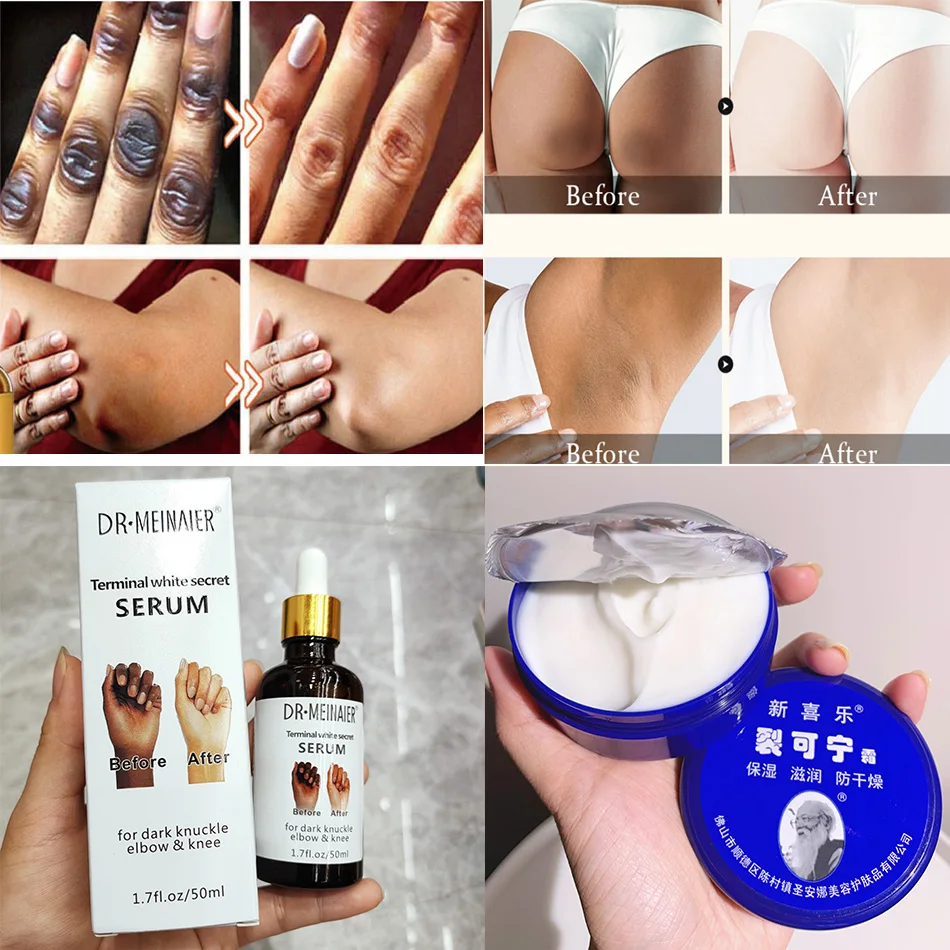 

Get Rid Of Dark Knuckles In 7 Days Serum Whitening Removing Dark Knuckles Serum Hand Knuckle Eraser Serum For Elbow And Knee