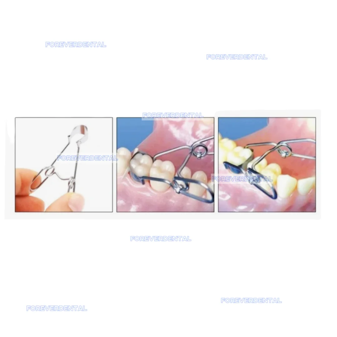 1.310 Dental Saddle Contoured Metal Matrices Matrix 50um Thick Universal Kit with Spring Clip 1.003