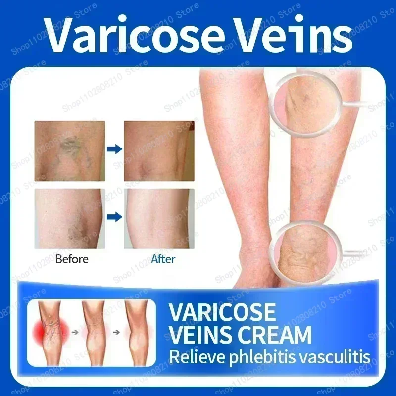 Cream leg skin irritates and soothes venous tension