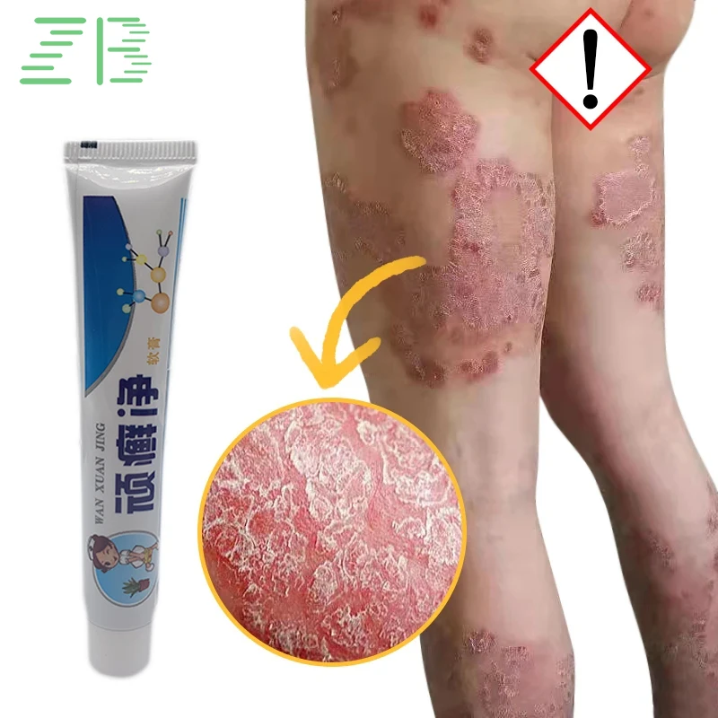 

Skin Psoriasis Ointment Eczema Dermatitis Scalp Hand Tinea Antibacterial Repair Care Cream Foot Tinea Antipruritic Dressing