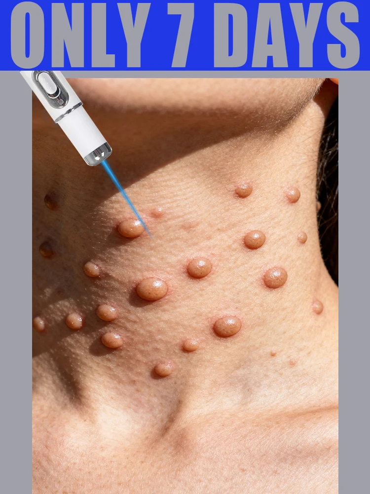 Remoção de verrugas a laser para tratamento de pescoço, obtenha verrugas cauterizador creme de verrugas adulto