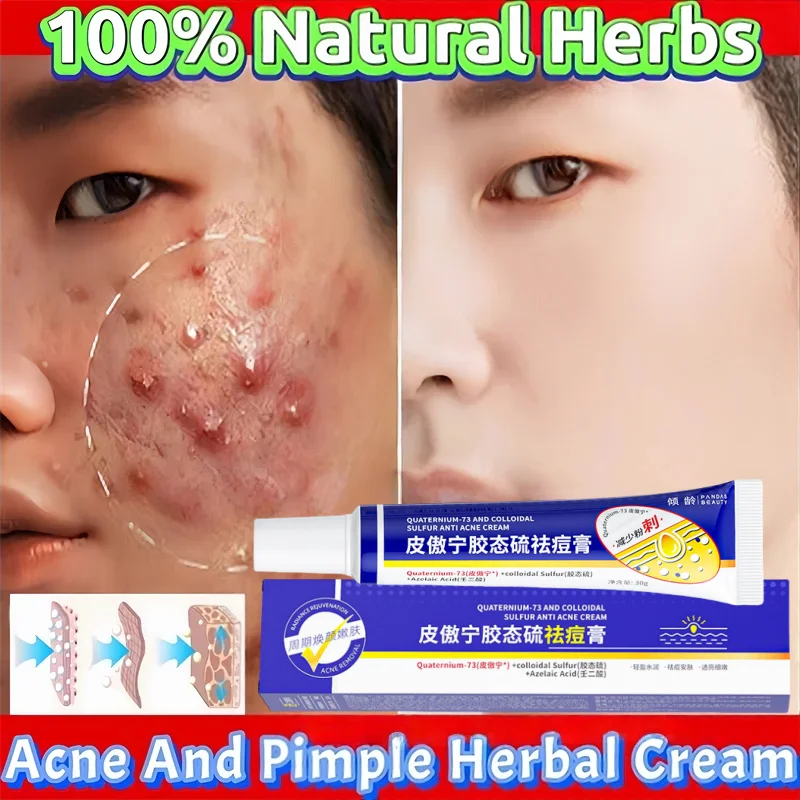 

Herbal Acne Removal Face Cream Clears Pimple Scar Black Dots Gel Acne Treatment Shrink Pore Skin Whitening Lightening Ointment