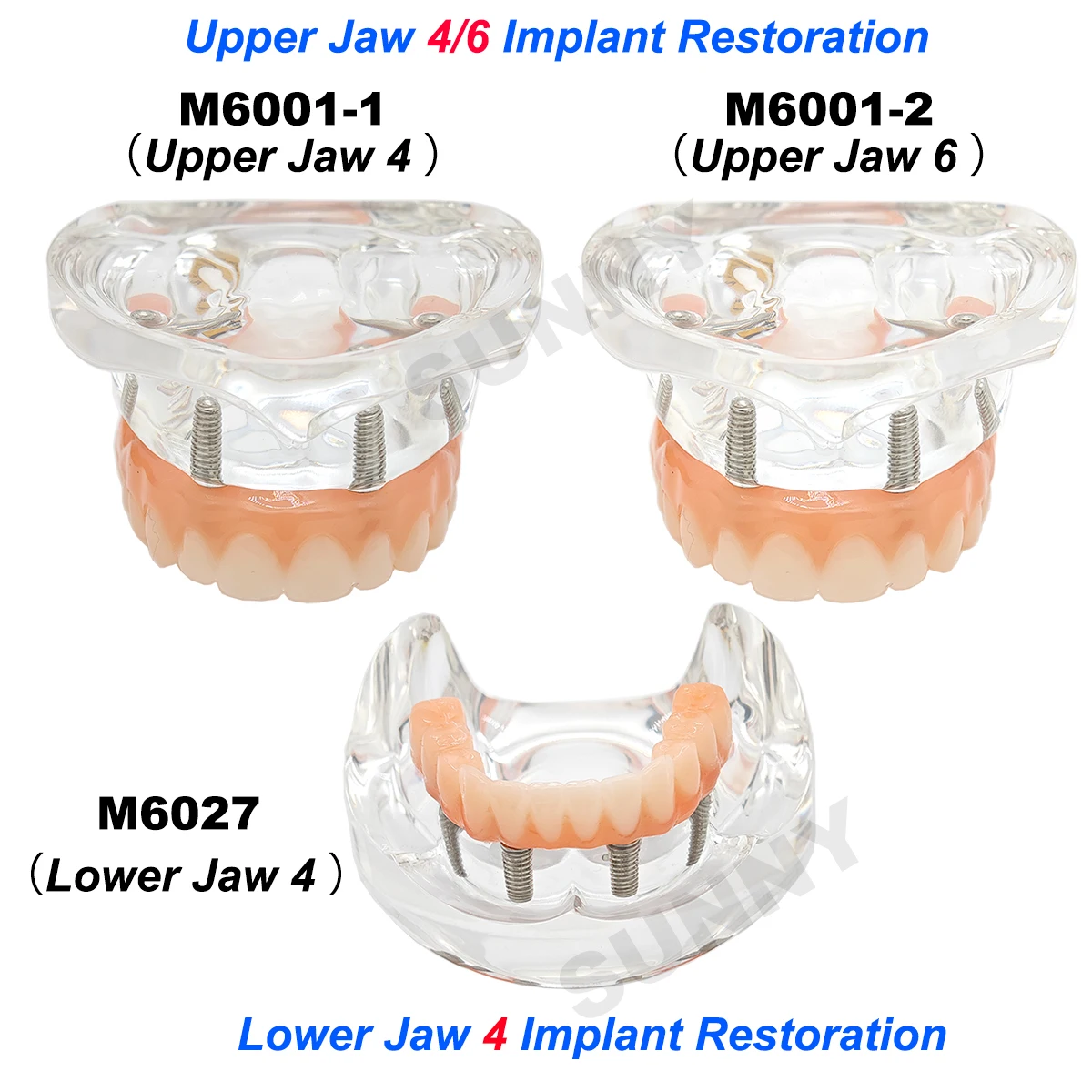 Dental Model Teeth Model upper jaw/Lower Jaw Implant Restoration Model Dentist Patient Communication Treatment Study Demo