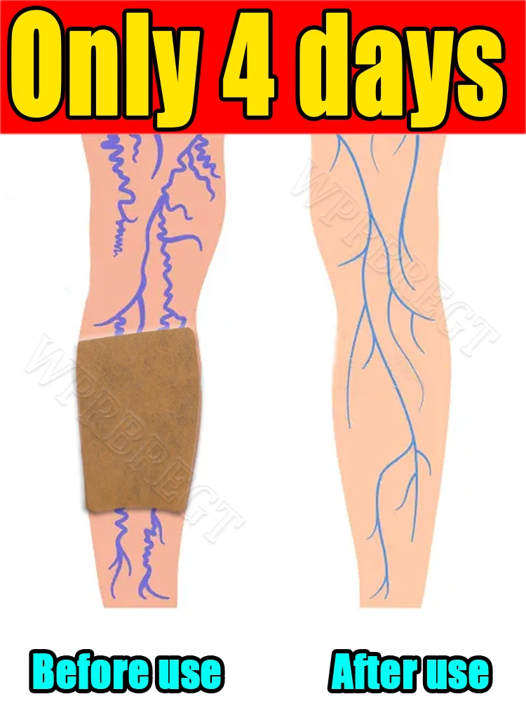 

95% покупки клиентов: патчи для веней 2-го поколения почти безболезненное лечение.