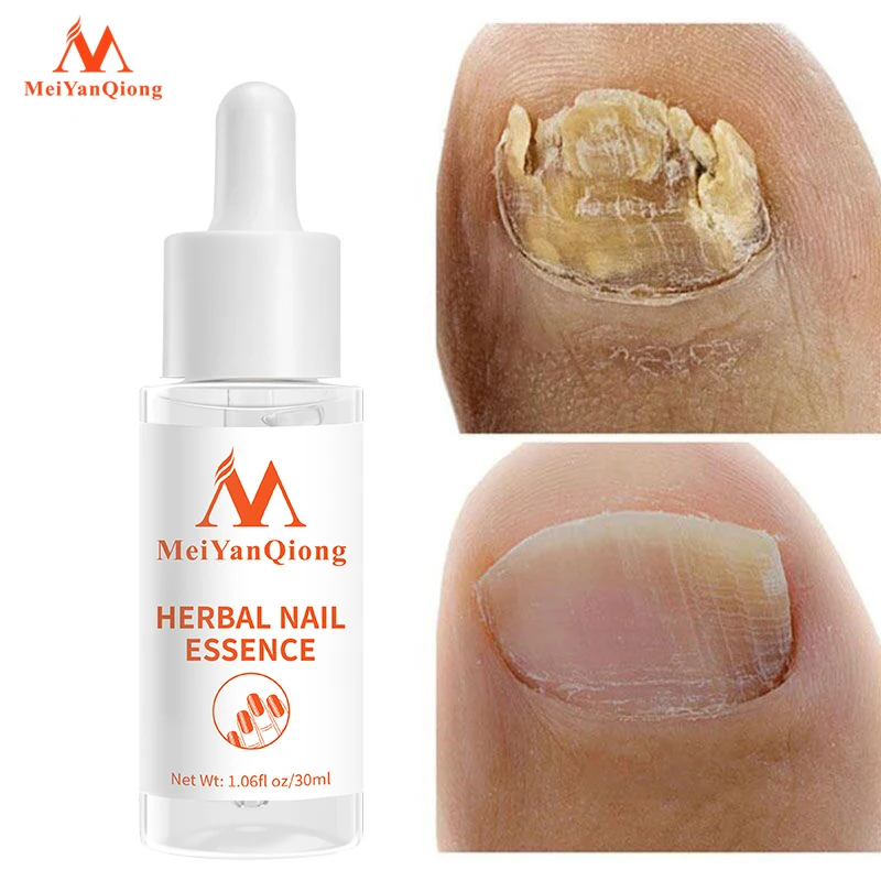 Nail Treatment Feet Care Essence Nail Foot Whitening Toe Nail Fungus Removal Gel Anti Infection Paronychia Onychomycosis