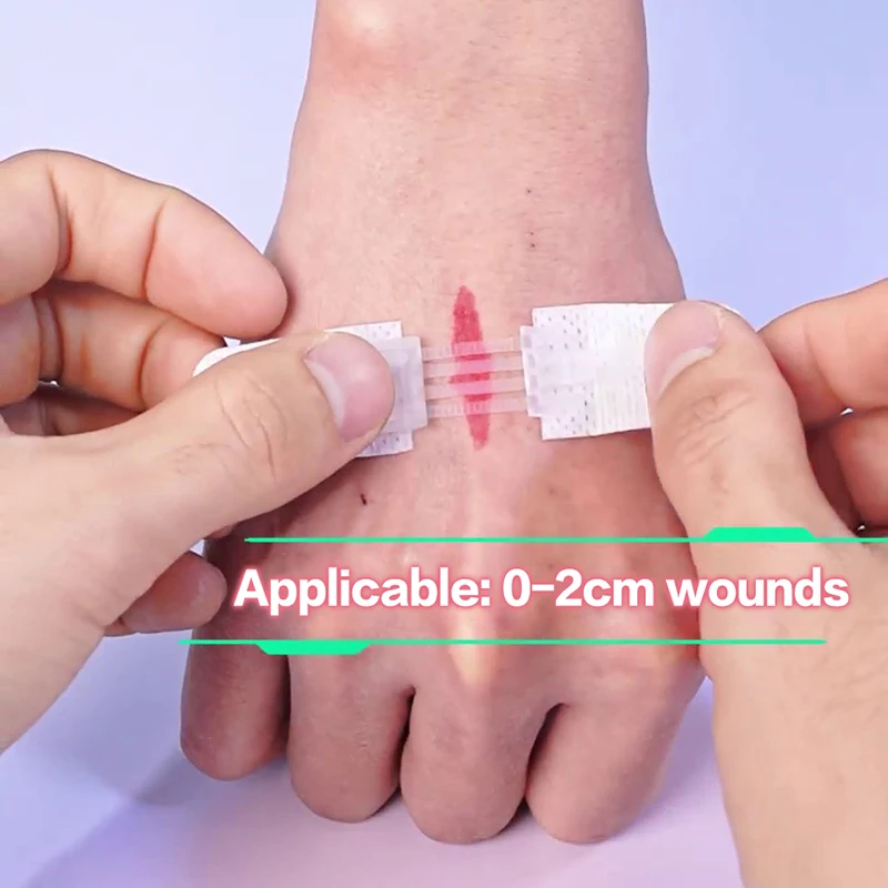 

1 шт., пластырь на молнии, безболезненное устройство для закрытия ран, пластыри для перевязки на рану без швов, пластырь для уменьшения швов на молнии, пластырь