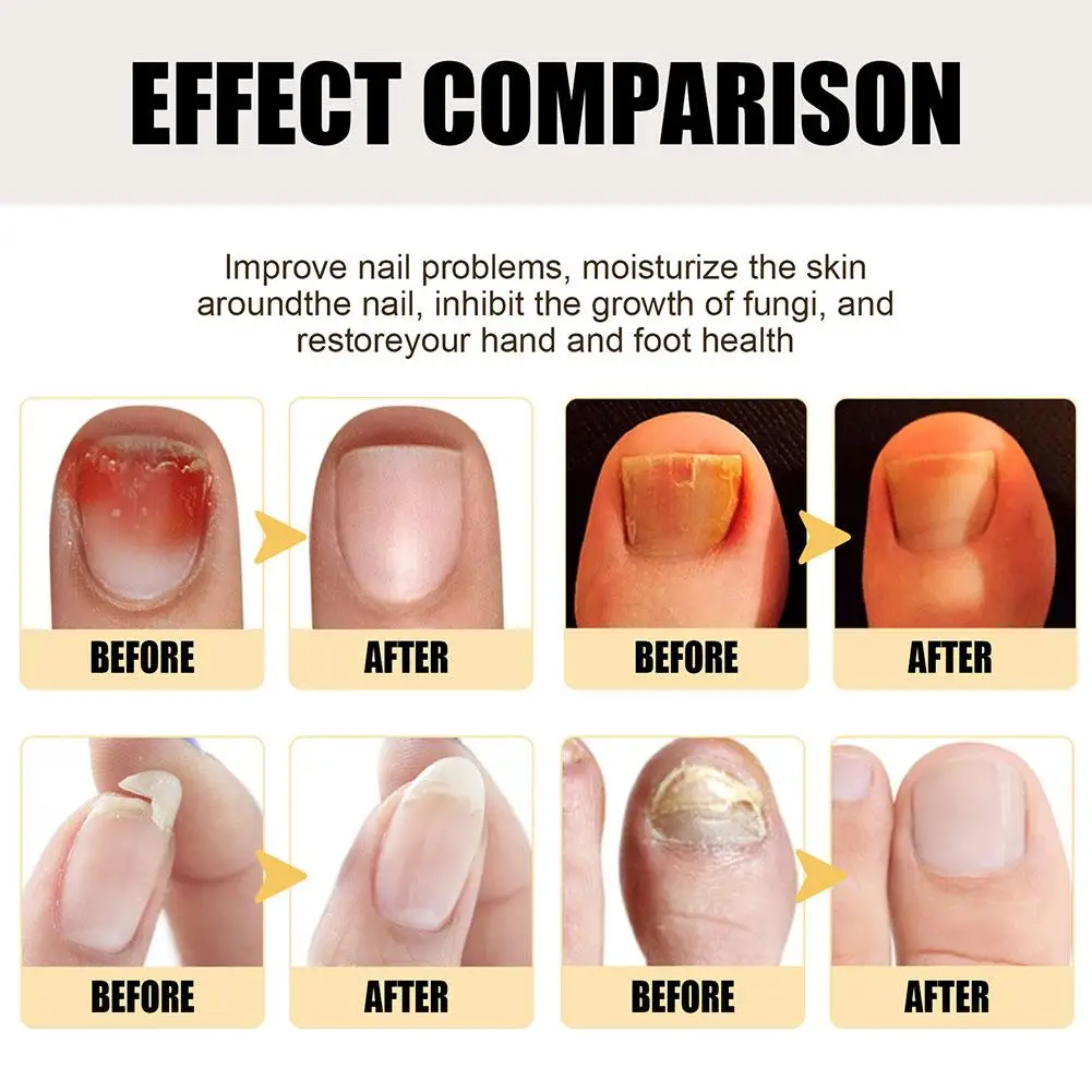 20ml Nail Fungus Treatment Essence Serum Care Serum Nails Serum Removal Anti-Infect Care Gel Fungal Cuticle Repair Hand And P8I3