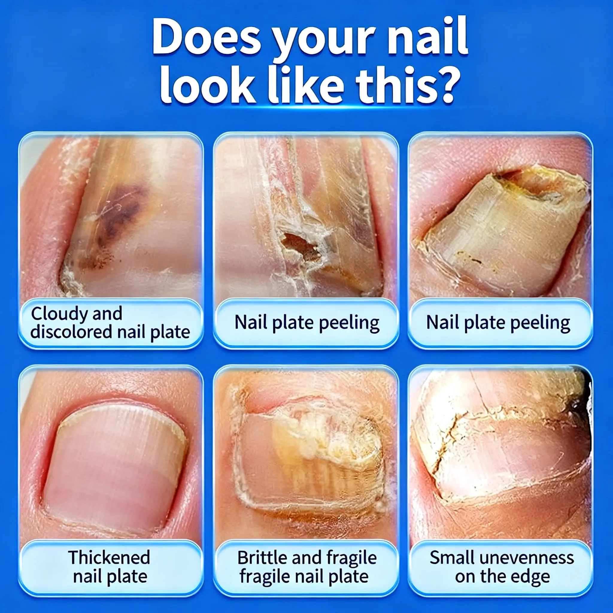 سائل تعقيم فطريات الأظافر 30 مل - العناية بالأظافر فطار الأظافر يساعد على تحسين متشقق متغير اللون لأظافر القدم والأظافر