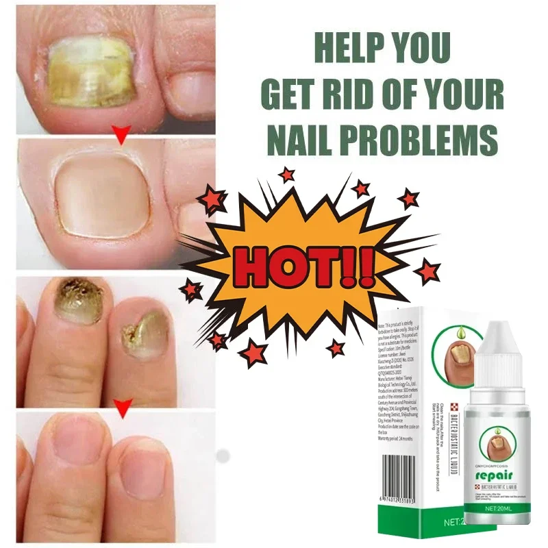 Fungal Nail Treatment Serum Foot Nail Fungus Removal Repair Gel Anti Infection Paronychia Onychomycosis Foot Nails Care Essence