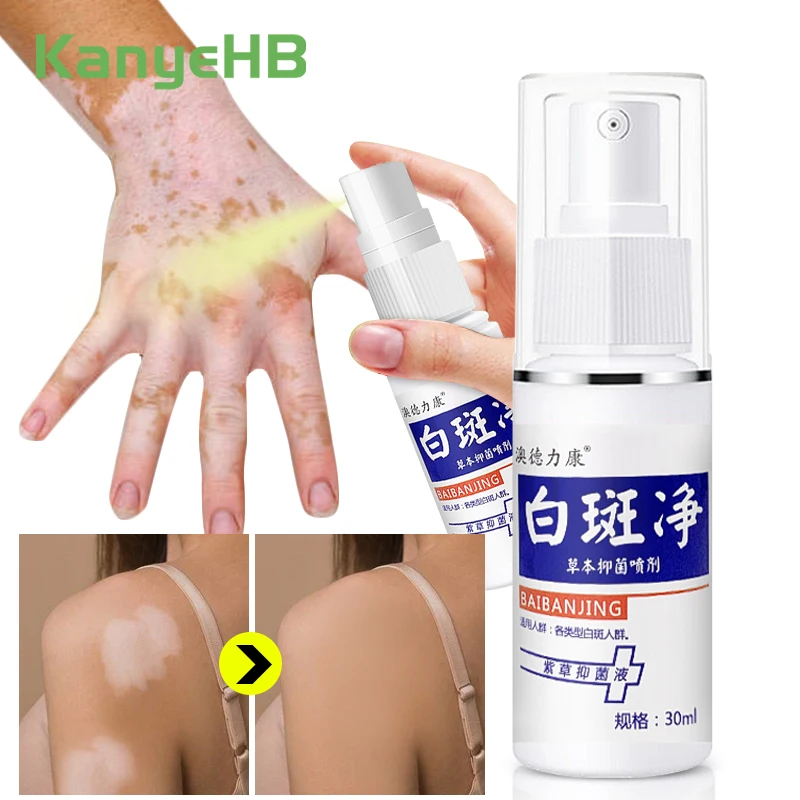 

1Pcs White Spot Vitiligo Treatment Spray Antibacterial Psoriasis Localized Leukoplakia Mycosis Chinese Herbal Medical Spray S096