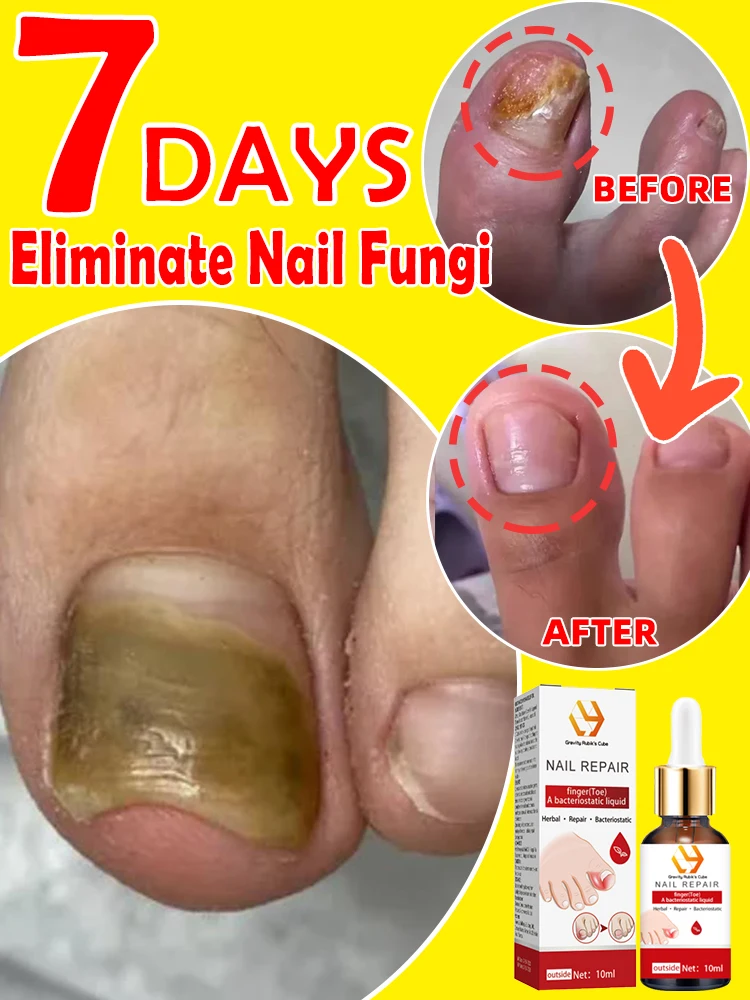 Recuperative nails fungus foot.