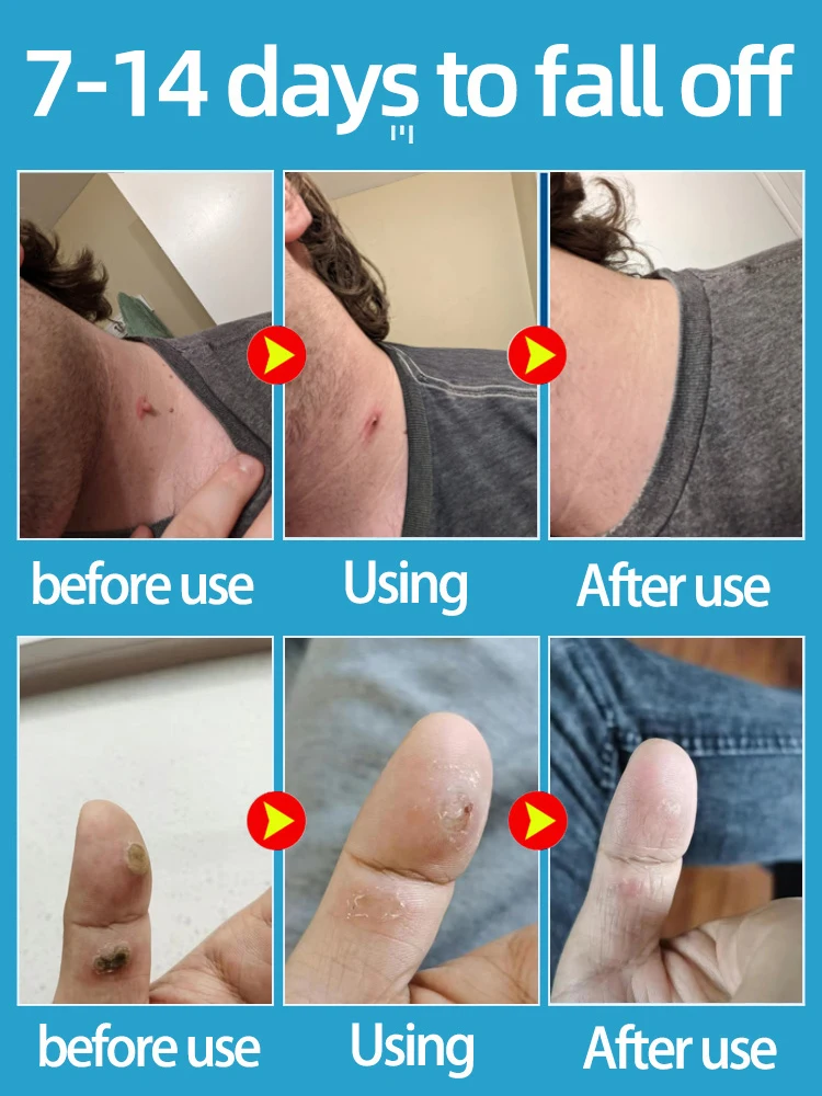 Warts-Removal