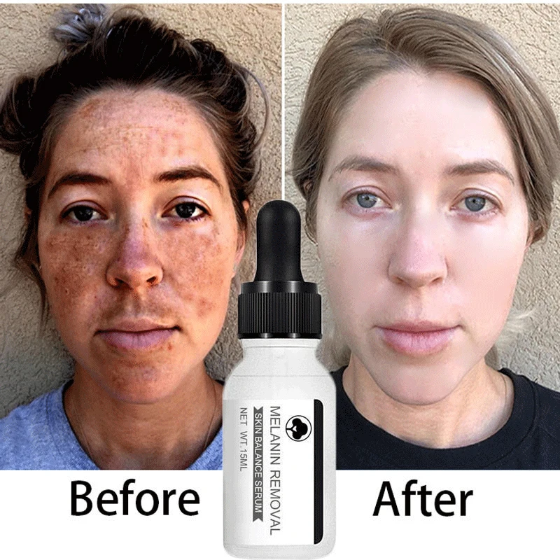 Powerful Removal Dark Spots Black Dot Melasma Chloasma Whitening Face Cream Niacinamide Freckle Removing Moisture Face Skin Care