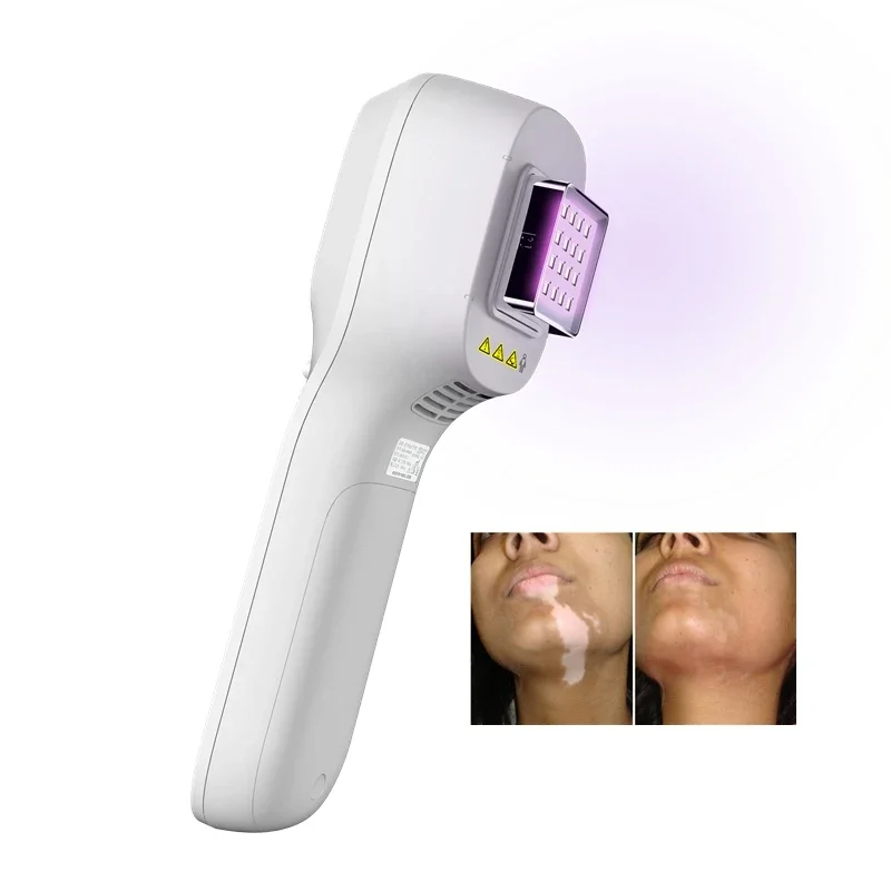 Kernel KN-5000H handheld portable LED 308nm UVB light therapy machine for targeted treatment of psoriasis vitiligo