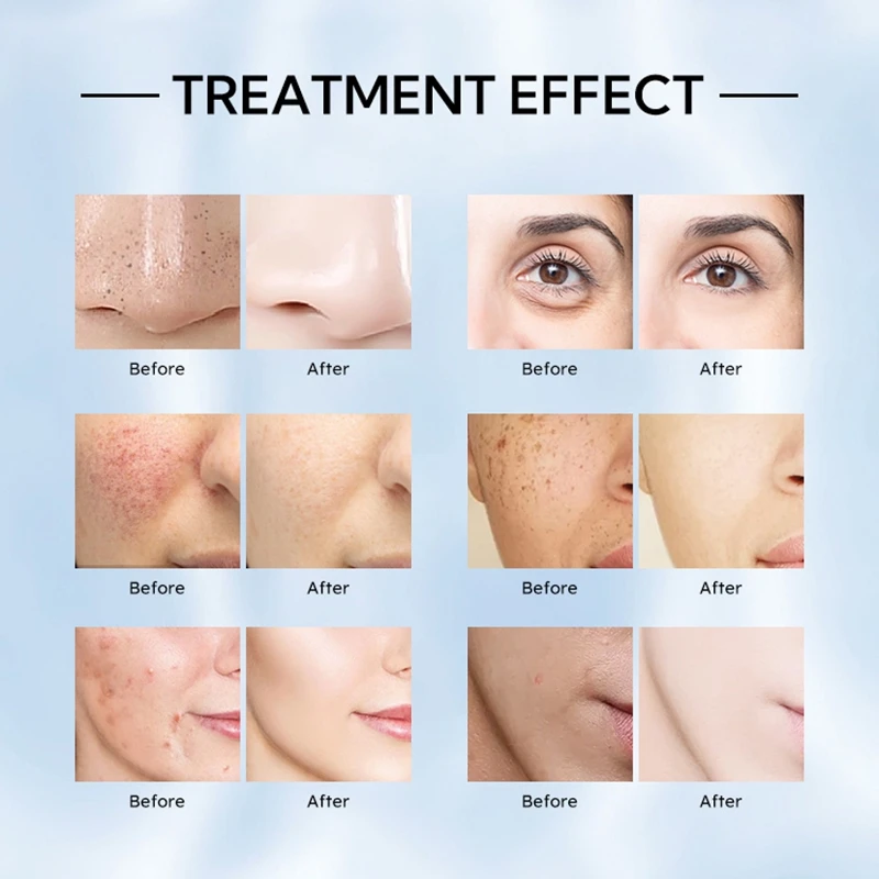 4-in-1 เปิดตัวเครื่องทําความสะอาดผิวหน้าแบบมืออาชีพ Hydra Skin Deep และ Anti-aging พร้อมอุปกรณ์ขัดถู Microcrystalline