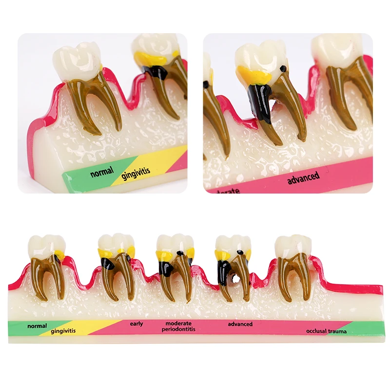 1pc Disease Tooth Model Dental Teaching Models Doctor-Patient Communication Tools Periodontal Caries Breakdown Display Models