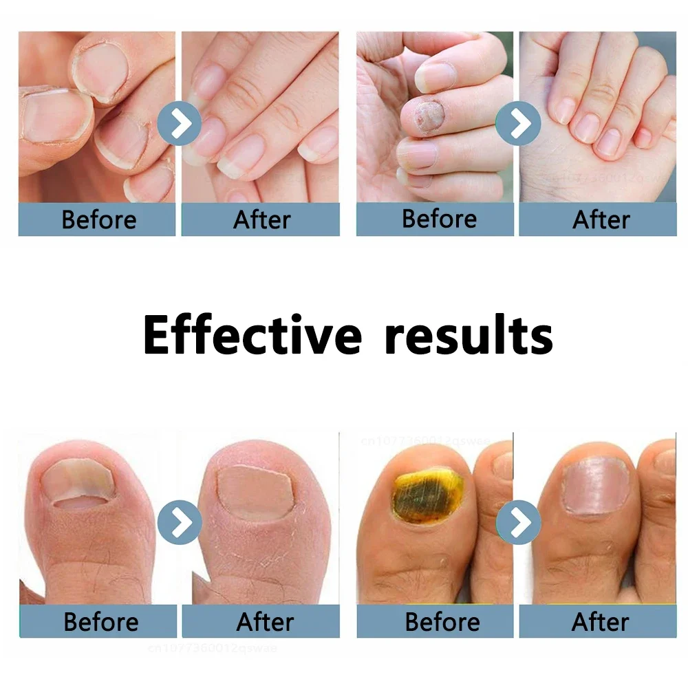 Dispositivo de hongos Lase r para uñas de los pies múltiples, onicomicosis, reparación de uñas, equipo antifúngico Lase r