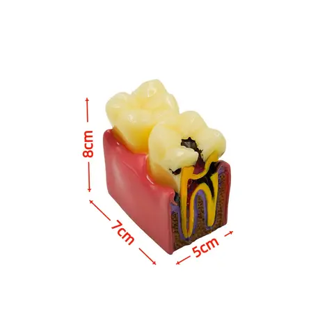 Dental 6 Times Caries Comparsion Tooth Models Study Models For Dentist Studying Teaching Anatomy Practice Dentistry Teeth Model
