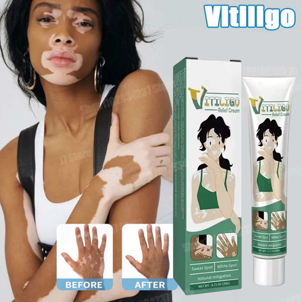 Effectively Remove White Spot Removal Skin Vitiligo Eliminate Vitiligo Body Skin Care1