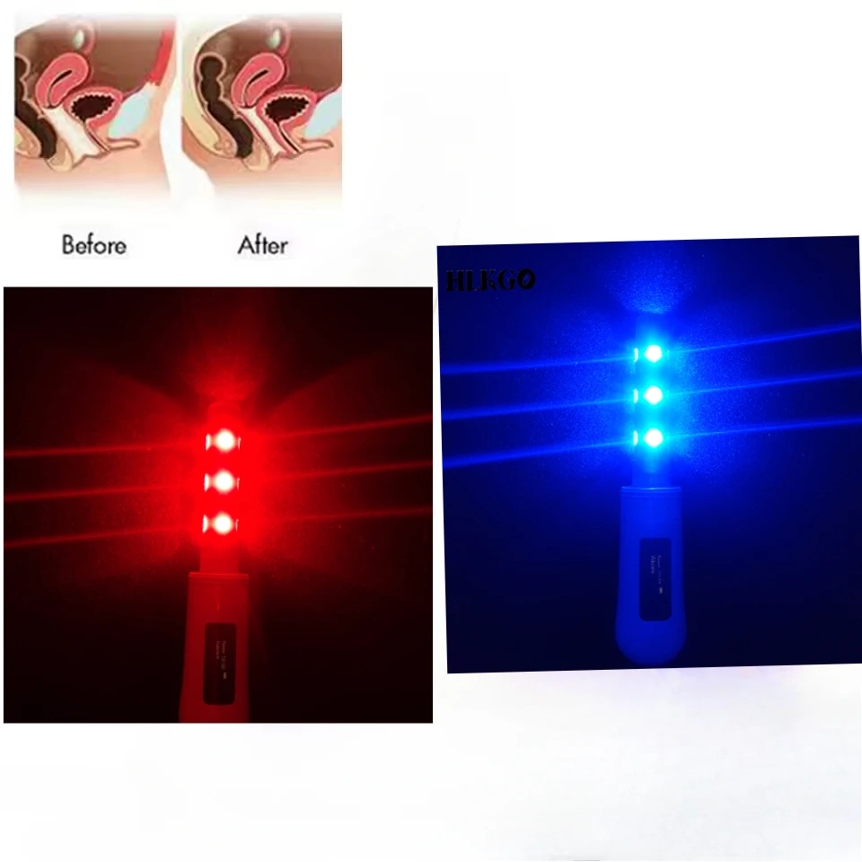 

Gynecological Disease Laser Therapy Device Pelvic Infection Vaginal Tightening Vaginitis Treatment