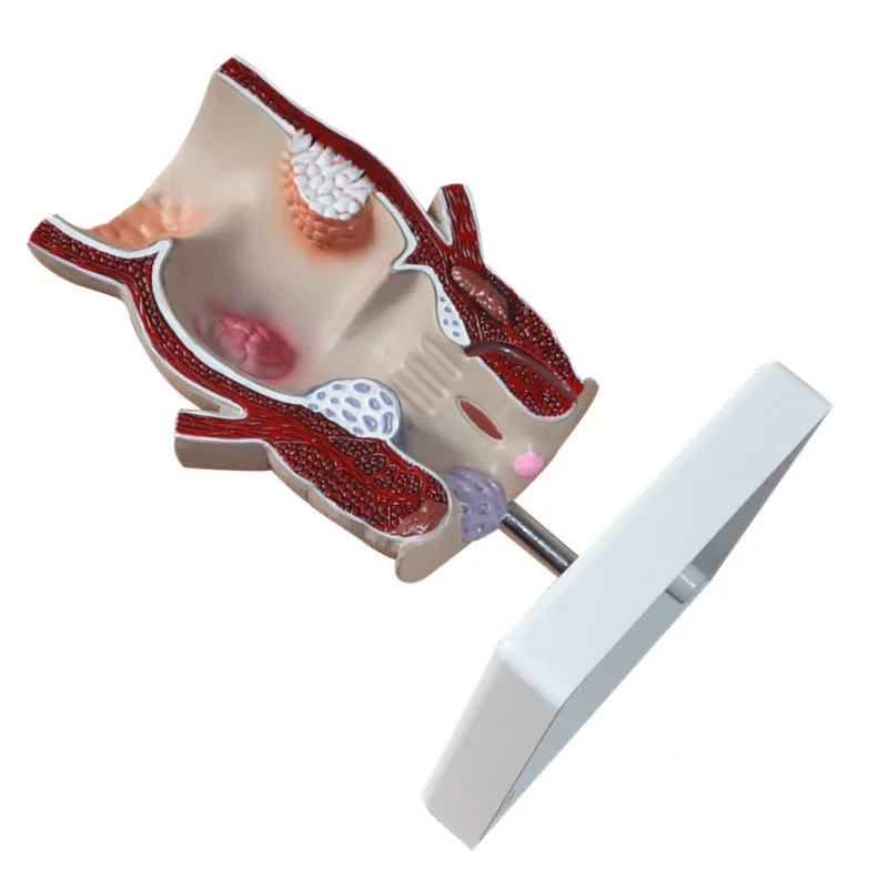 Medical anatomical models for anorectal research using a rectal pathological model of hemorrhoids