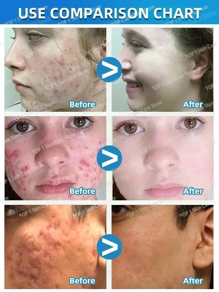 

Face Serum Fruit Acid Acne Treatment Oil Control Remove Blackheads Shrink Pores Skin Texture Improve Care