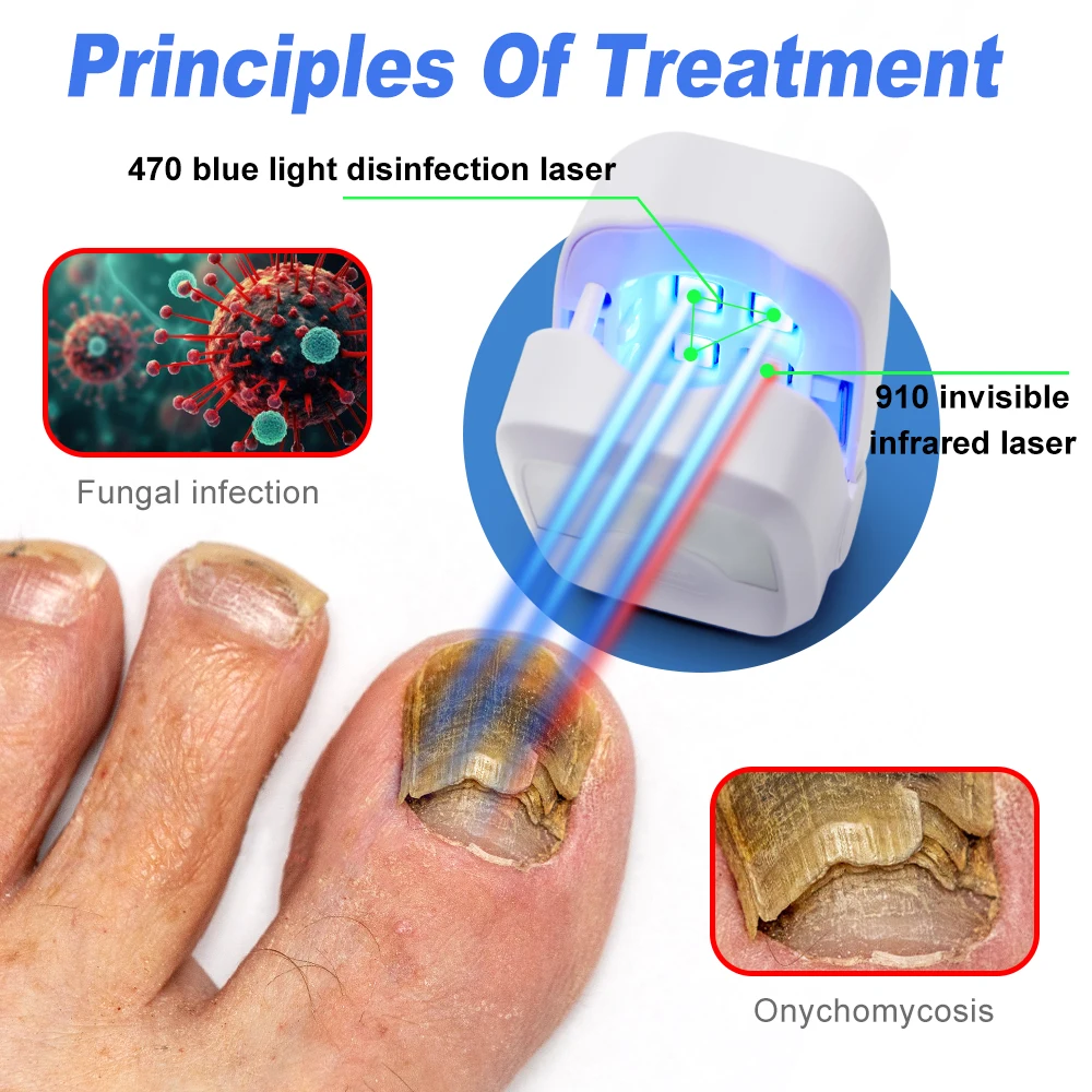 Dispositivo do tratamento do laser do fungo do prego, Reparo da unha, Unha Fungus Treat, Unhas do laser do onicomicose com relaxamento dos cogumelos