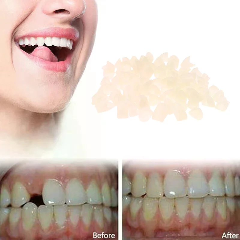 1bag Dental Temporary Crown Material Anterior & Molar Teeth Veneers Resin Temporary Tooth Repair Kit Gum Protection