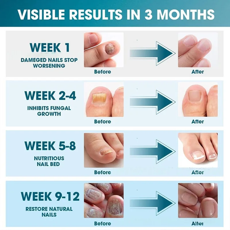 อุปกรณ์ทำความสะอาดเชื้อราที่เล็บสำหรับเล็บเท้าหลายอัน อุปกรณ์รักษาเชื้อราที่เล็บด้วยแสงอินฟราเรด 905 นาโนเมตร ปลอดภัยและเชื่อถือได้