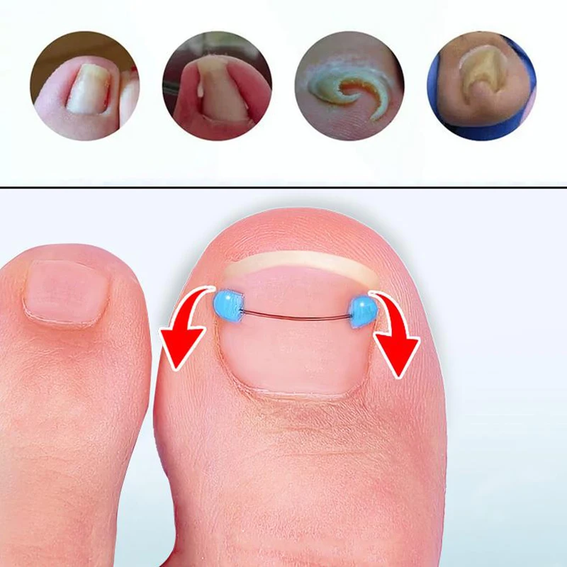 Juego de cables de corrección azul para uñas encarnadas, cuidado de los pies, tratamiento profesional, recuperación, pedicura de uñas, herramienta alisadora de dedos