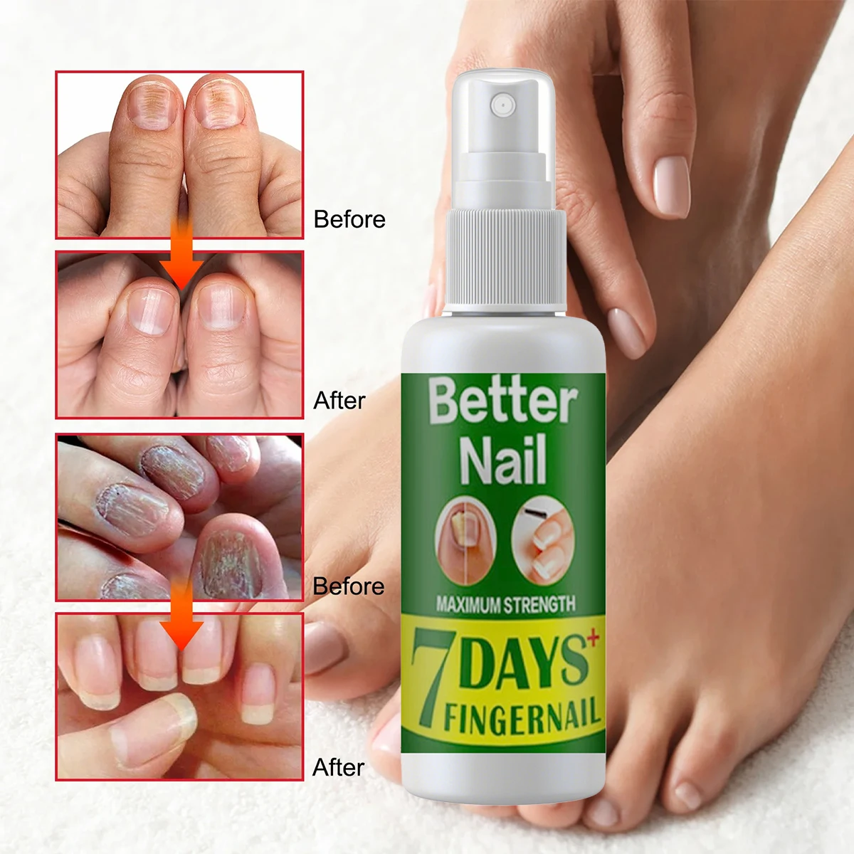 Spray de reparación de uñas fungicida, tratamiento de enfermería, eliminación de hongos en las uñas de los pies, Gel antibacterial, cuidado de la paroniquia y onicomicosis