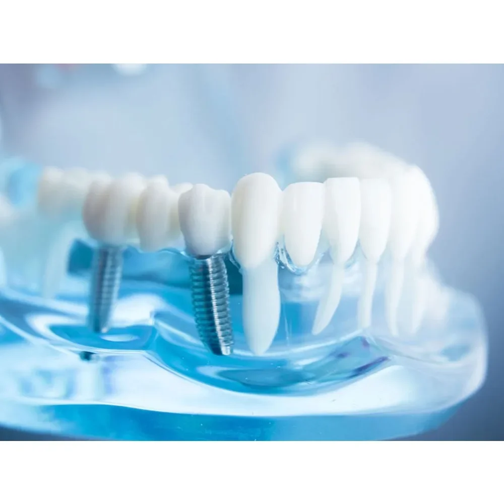 Tooth Implant Dental Clinic Medical Teeth Wall Art Picture Posters Canvas Paintings Living Room Bedroom Decoration Home Decor