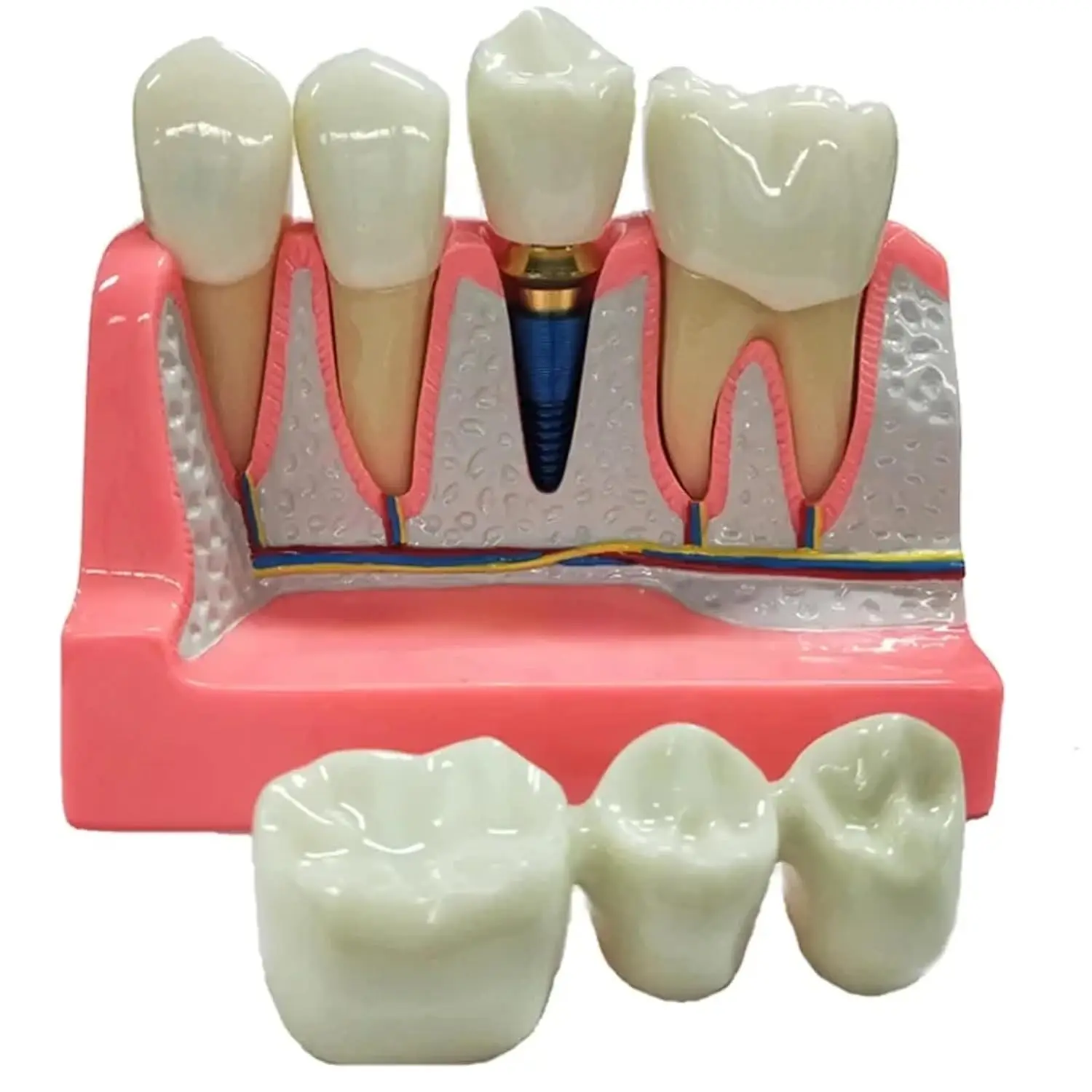 

4 Times Dental Implant Teeth Model Analysis Crown Bridge Demonstration Removable Model Dentist Teaching Study Training Model