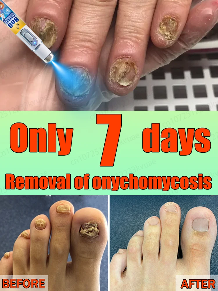 

Say goodbye to onychomycosis, no recurrence, no damage to nails.
